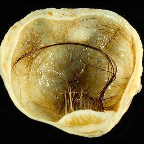 dermoid-cyst-of-the-ovary1