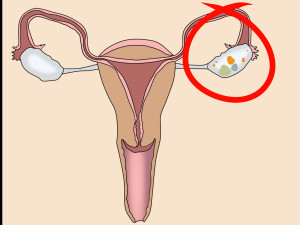 виды кисты яичника во время беременности