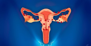 виды кисты яичника у женщин - эндометриоз