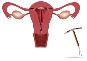 лечение кисты гормональными контрацептивами