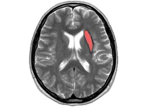 ретроцеребеллярная арахноидальна киста головного мозга