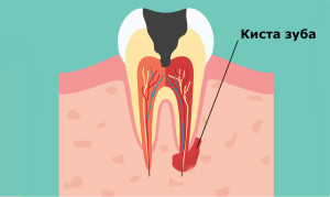 радикулярная киста зуба - виды кисты зуба