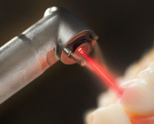 удаление кисты зуба лазером - лечение кисты зуба