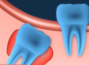 фолликулярная киста зуба - виды кисты зуба